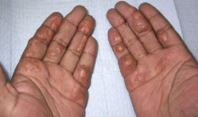 Etobur Diyeti ve Yan Etkileri: Sağlık Üzerindeki Tehlikeleri