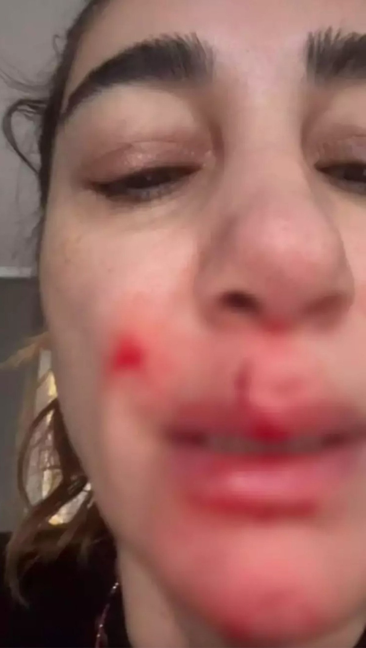 Nadide Sultan Kaza Geçirdi: Dudağına Dikiş Atıldı