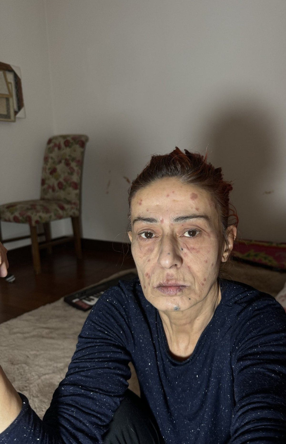 Yıldız Tilbe Kimyasal Yanık Geçirdi