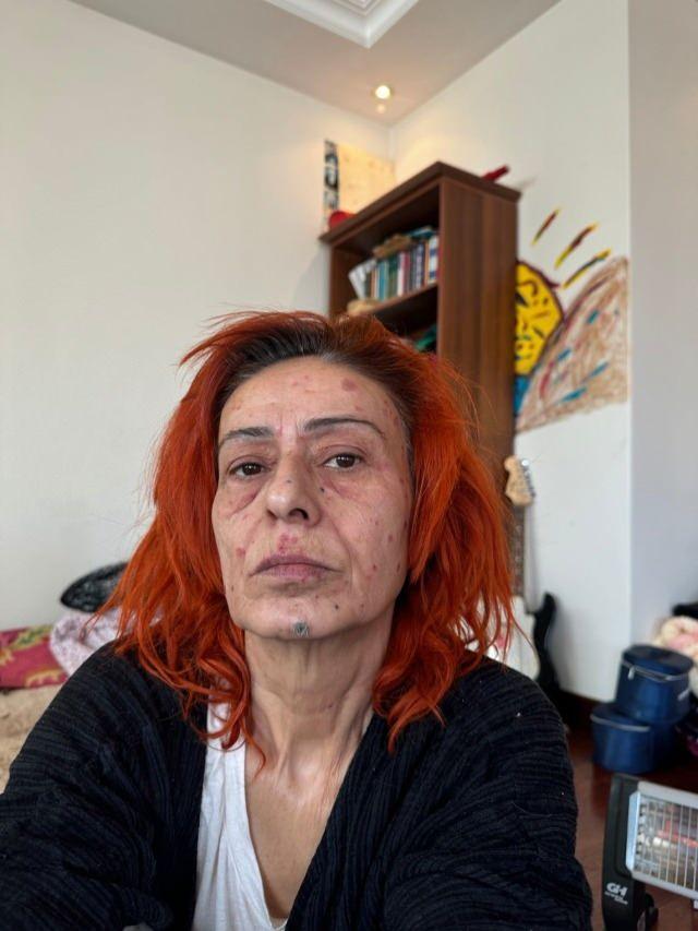 Yıldız Tilbe'nin Saç Boyama Kazası: Yanıklar ve Tedavi Süreci