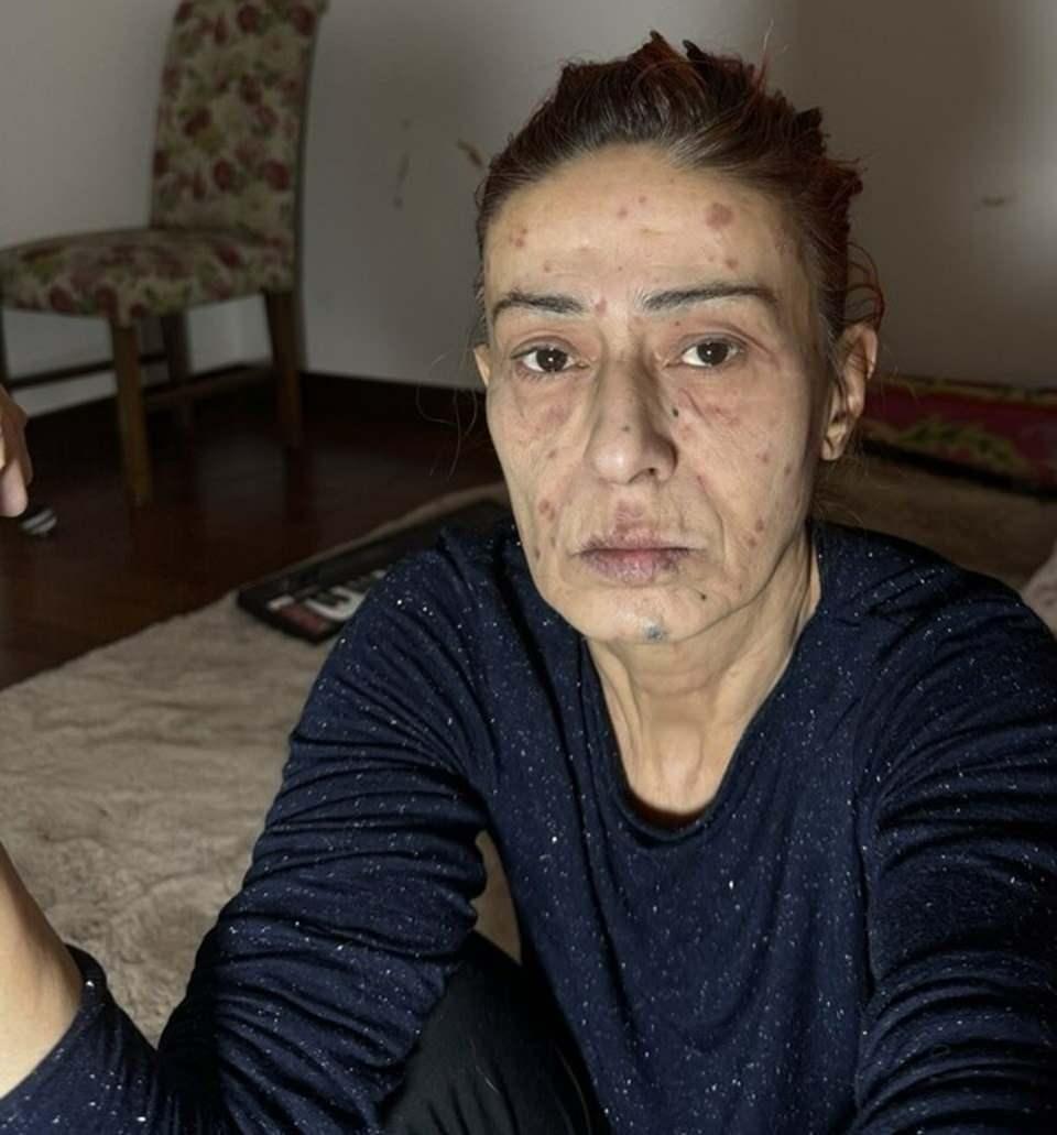 Yıldız Tilbe'nin Saç Boyama Kazası: Yanıklar ve Tedavi Süreci